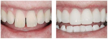 реставрация зуба 2.jpg