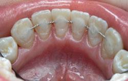 Шинирование зубов с помощью металлической лигатуры.jpg